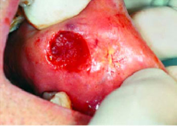 Dento-Alveolar Surgery