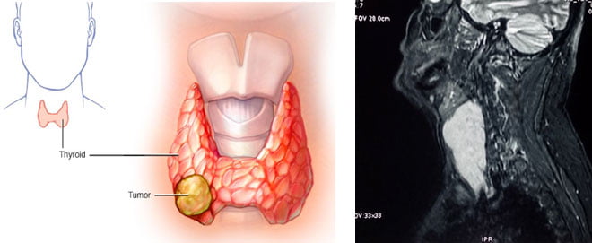 thyroid cancer