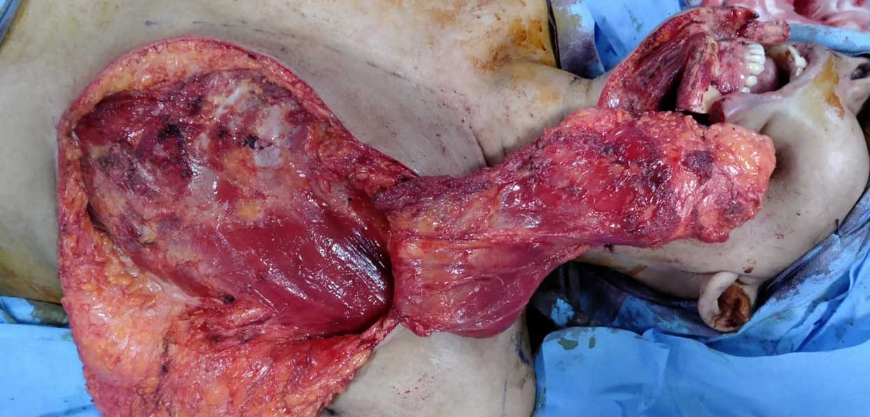 Metastasis of Renal Cell Carcinoma (RCC)