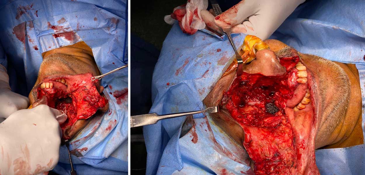 Treatment of Rhinocerebral Mucormycosis