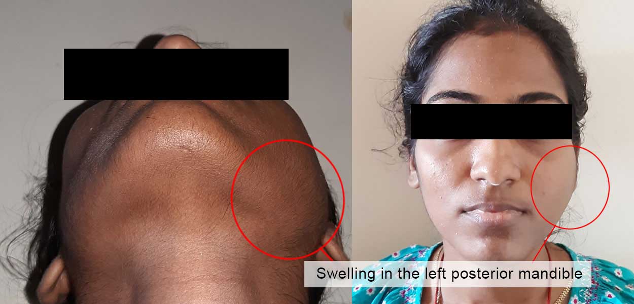 A Case of Benign Cystic Tumour