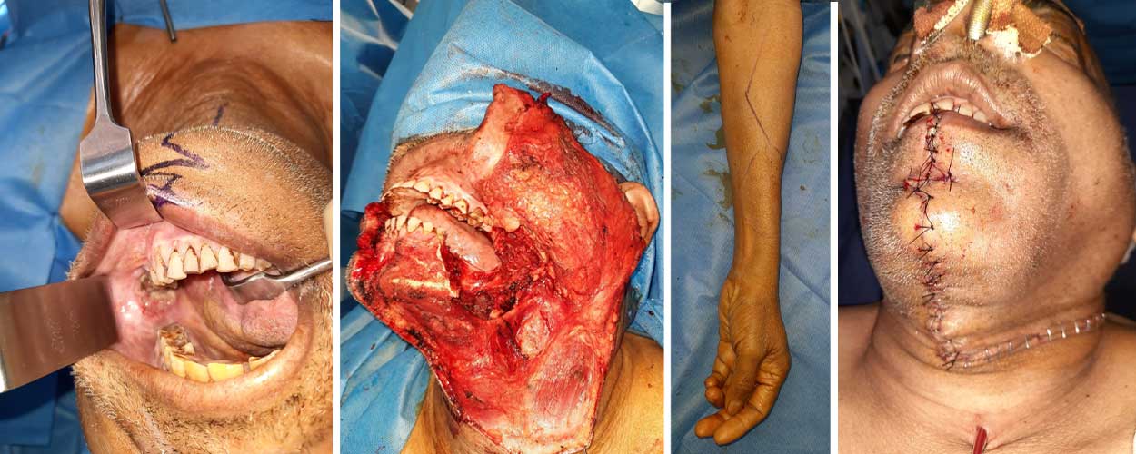 Carcinoma of Retromolar Trigone