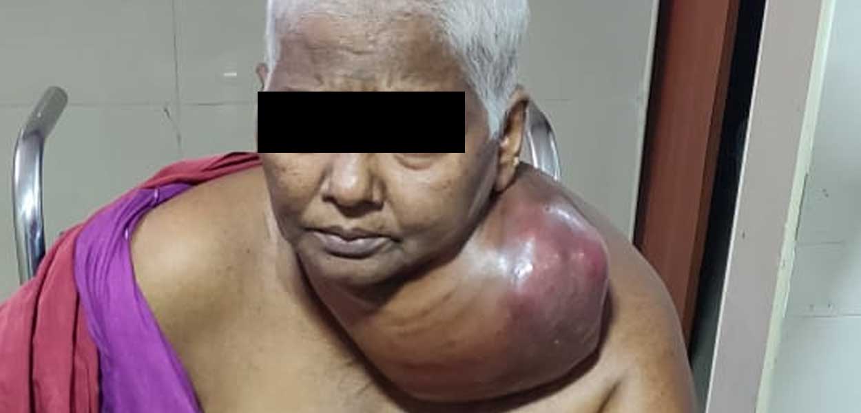 Metastatic Ovarian Cancer Presenting as Neck Tumour