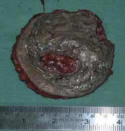 Squamous Cell Carcinoma of the Pectoralis Major Myocutaneous Flap Donor Site