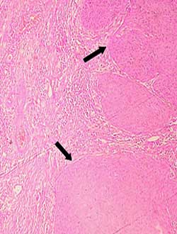 Prognostic and Predictive Factors in Gingivo Buccal Complex Squamous Cell Carcinoma